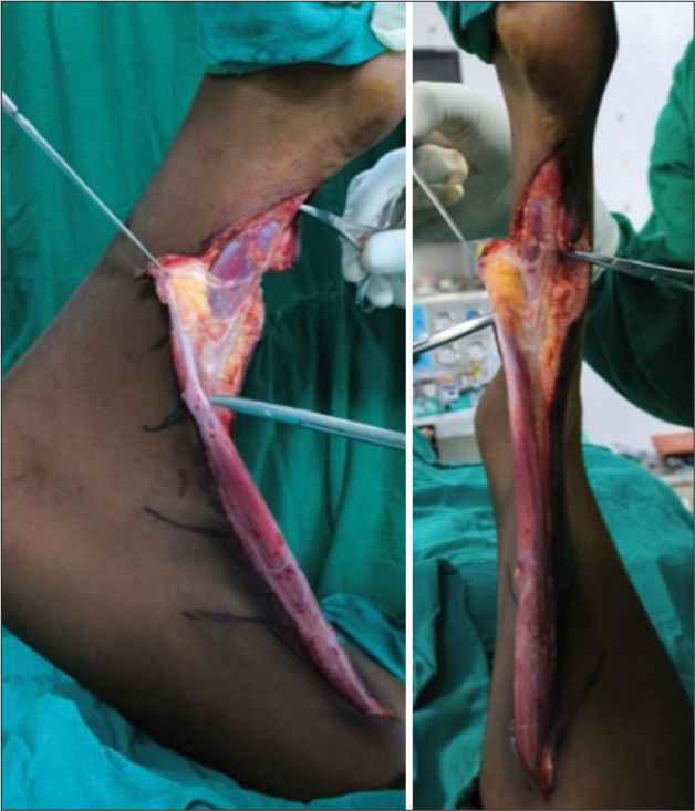Intraoperative findings showing abnormal insertion of hamstring muscles.