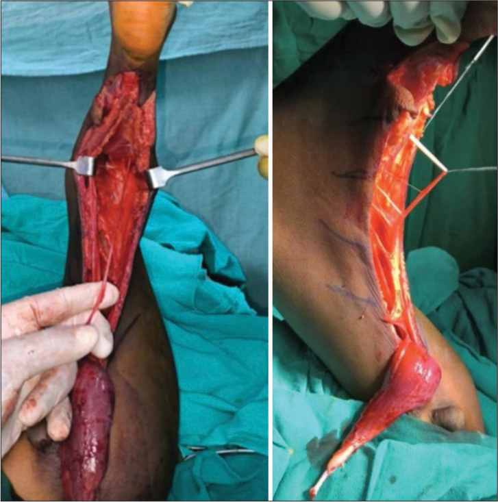 Intraoperative findings showing multiple fibrous band attachments seen between tendons and thigh muscles.