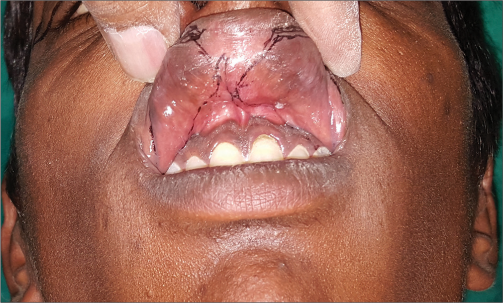 Elliptical excision markings on either side of frenulum.