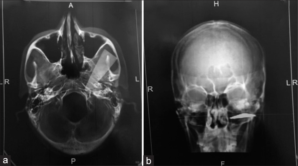 (a and b) Computed tomography screen with mandibular impression.