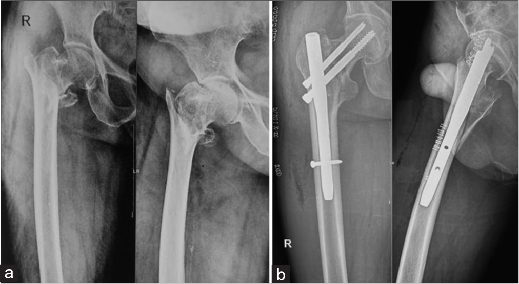 A 72-year-old female patient with intertrochanteric fracture fixed with proximal femur nail. (a) Pre-operative radiograph. (b) Immediate post-operative radiograph.