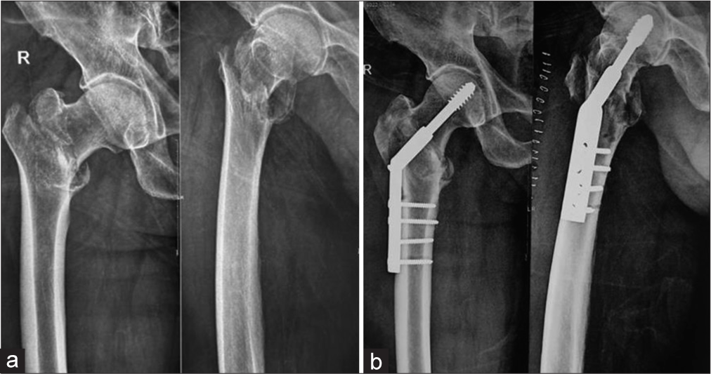 A 68-year-old male patient with intertrochanteric fracture fixed with dynamic hip screw. (a) Pre-operative radiograph. (b) Immediate post-operative radiograph.