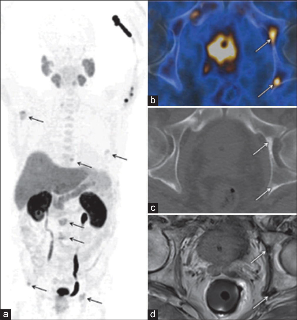 18F-Choline PET/CT and MR imaging of a 72-year-old man with newly diagnosed prostate cancer (Gleason score, 5+5 =10). (a) Late coronal maximum intensity projection image from 18F-Choline PET/CT shows focal tracer uptake in multiple bone lesions (arrows). (b) Axial fused PET/CT image of the pelvis depicts intense focal tracer uptake (arrows) in the left acetabulum, which helps confirm the findings in (a). (c) Axial CT image shows minimal sclerotic changes (arrows) in the left acetabulum. (d) Corresponding axial T1-weighted MR image shows minimal hypointense changes (arrows) in the left acetabulum. PET/CT: Positron emission tomography/computed tomography, MR: Magnetic resonance.