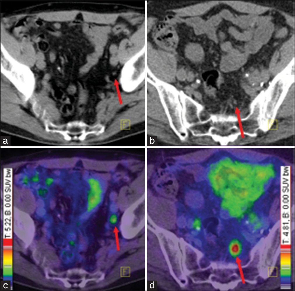 Ga-68 PET CT demonstrating two different patients with small lymph node metastases and different intensity of tracer uptake. Tracer accumulation in lesions outside the prostate gland, should be regarded as prostate specific, until proven otherwise. Red arrows point to lymph node metastases. Colour scales were automatically produced by PET/CT machines. (a) CT of the first patient, (b) CT of the second patient, (c) fusion of PET and CT of the first patient, (d) fusion of PET CT of the second patient.