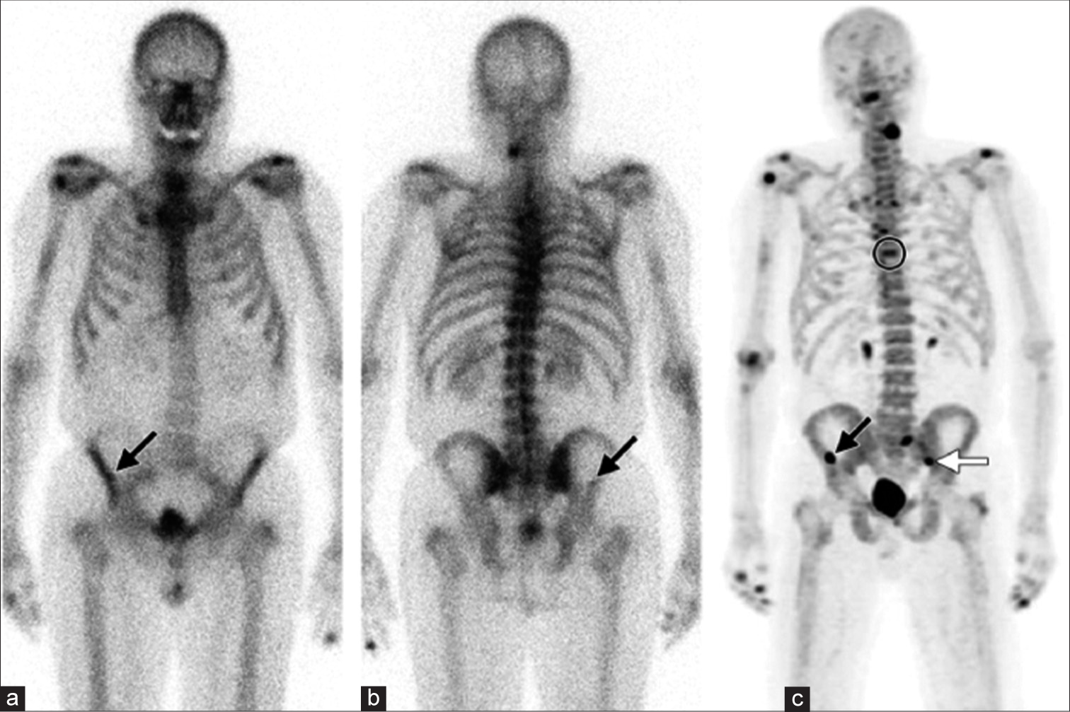 Unsuspected bone metastases in a 77-year-old man with prostate carcinoma and a rising prostate-specific antigen level. (a and b) Anterior (a) and posterior (b) 99mTc-MDP bone scintigraphic images show a small area of suspicious uptake (arrow) in the right iliac wing. (c) Anterior 18F-NaF PET MIP image helps confirm the right iliac wing lesion (black arrow) and shows additional previously undetected bone lesions in theT7 vertebral body (circle) and the left sacroiliac joint (white arrow). PET: Positron emission tomography, 18F-NaF: Fluorine-18-labelled sodium fluoride, 99mTc-MDP: Technetium-99m methylene diphosphonate.