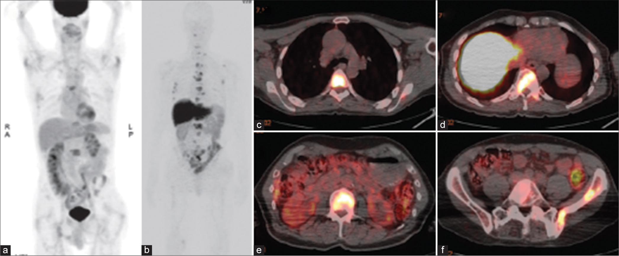 FDG PET and 89zr-J591 PET/CT of a 73-year-old man with metastatic castration-resistant prostate cancer. (a) Coronal maximum intensity projection image from FDG PET shows a few metastases to bone. (b-f) Coronal maximum intensity projection image from 89Zr-J591 PET (b) and axial fused 89Zr-J591 PET/CT images (c-f) depict many more metastases to bone. FDG: 18F-fluorodeoxyglucose, PET: Positron emission tomography, CT: computed tomography.