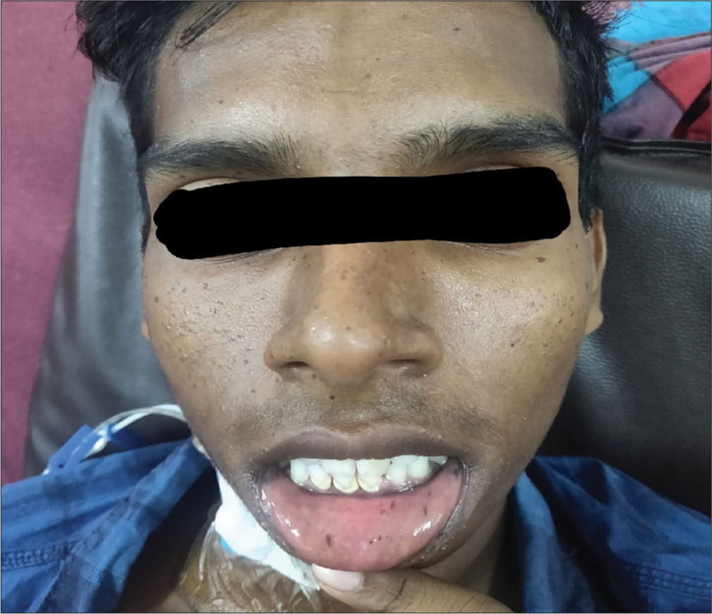 Mucocutaneous melanotic pigmentation.