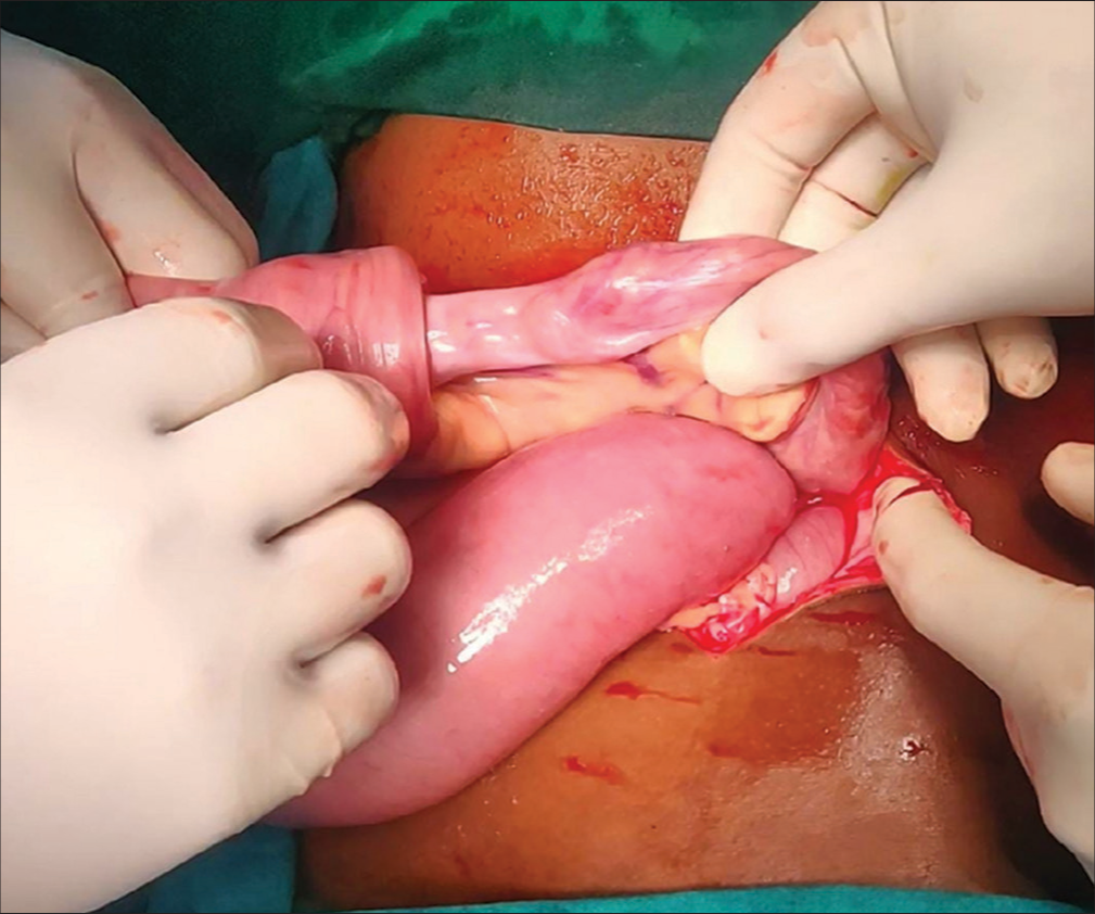 Ileoileal intussusception.