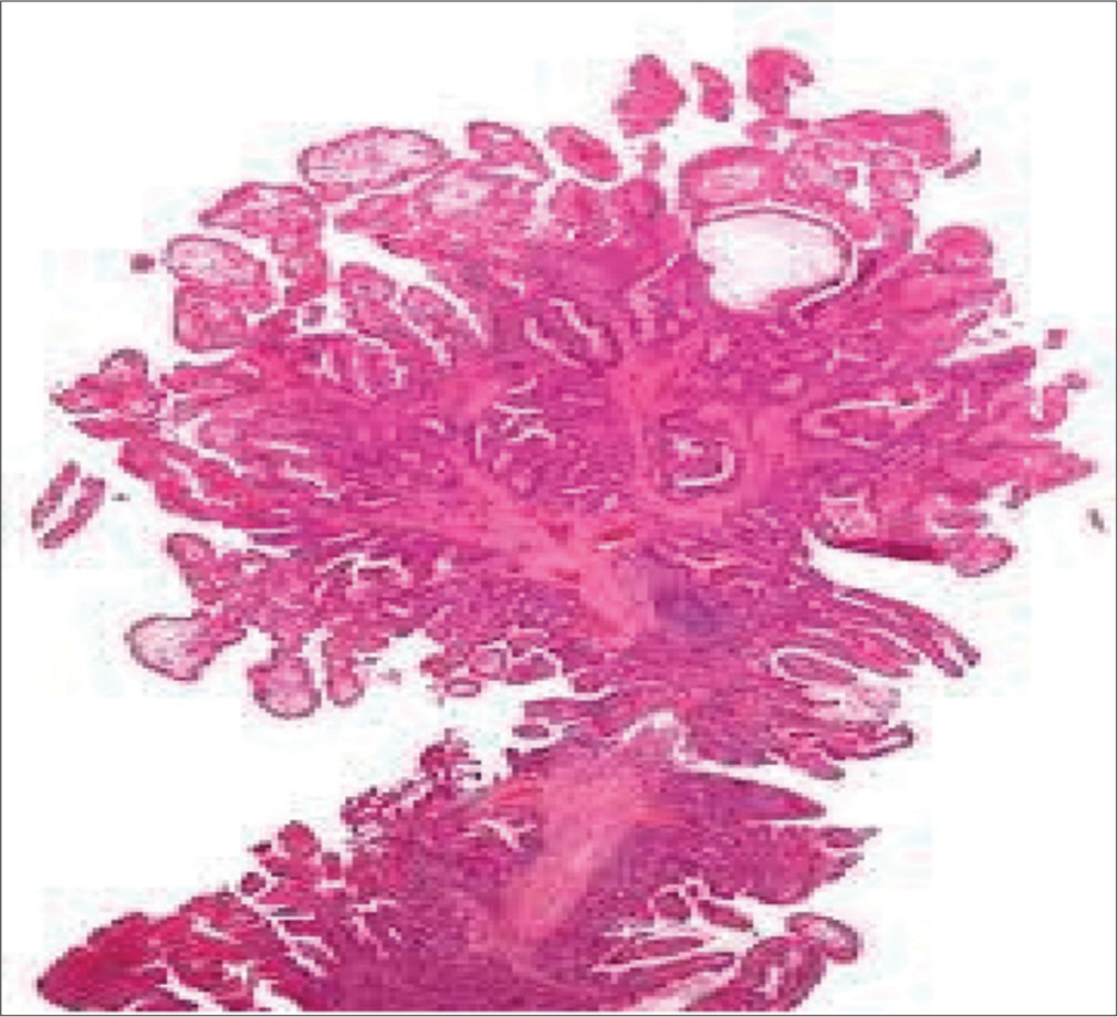 Arborizing pattern of a hamartomatous polyp.