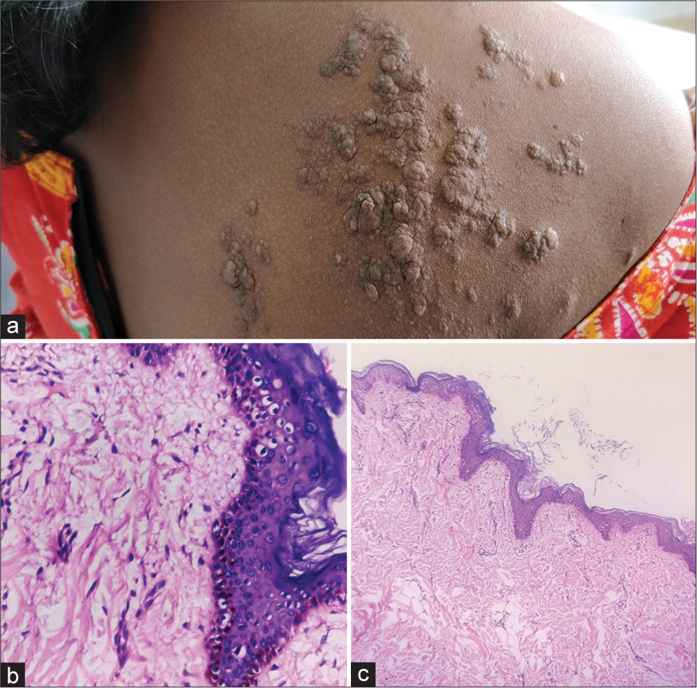 (a) Multiple skin coloured and few hyperpigmented papules and cerebriform nodules coalescing to form plaques seen in segmental distribution. (b) Adipose tissue island is seen almost reaching papillary dermis. (c) Hyperkeratosis, acanthosis, papillomatosis along with keratotic plugging. Dermis showed admixture of collagen and adipose tissue islands.